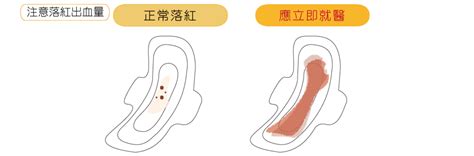 落紅|「3大產兆」破水．落紅．陣痛 ，代表即將臨盆？三分。